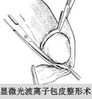 生殖整形