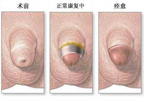 包皮過(guò)長(zhǎng)的圖譜